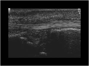 Tenosynovitis of the extensor carpi ulnaris tendon longitudinal