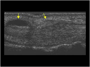 Thickened annular pulley and synovial cyst longitudinal
