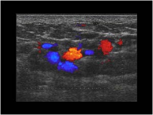 Vascular malformations in the upper leg