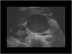 Liver cyst medial of the right kidney