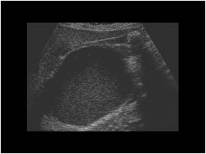 Liver cyst impressing the gallbladder