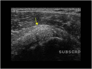 Subscapularis tendinosis with calcifications transverse