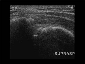 Total supraspinatus tendon rupture longitudinal