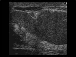 Ductectasia of the left breast filled with fluid with internal echos