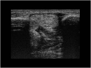 Interdigital lipoma between metacarpal 2 and 3 transverse dorsal view