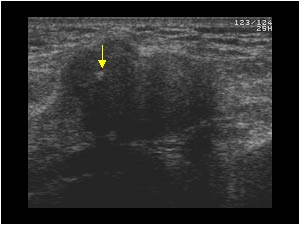 Synovial osteochondromatosis with tiny calcifications