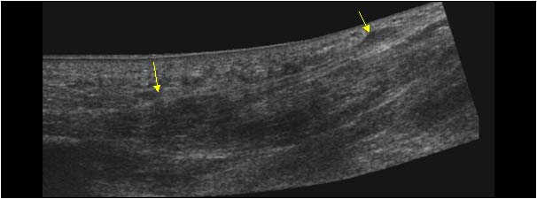 Multiple plantar fibromas in the left plantar fascia