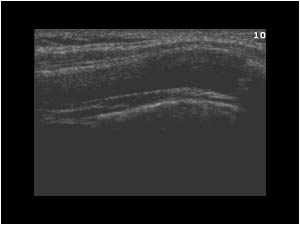 Prominence of the rib caused by an anterior curvature of the rib longitudinal