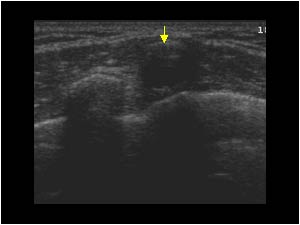 Prominence of the rib caused by an anterior curvature of the rib transverse