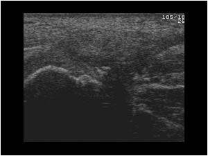 Thickened tendon insertion with calcifications longitudinal