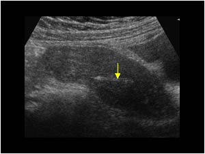 IUD in the posterior wall of the uterus longitudinal