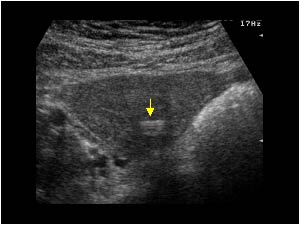 IUD in the posterior wall of the uterus transverse
