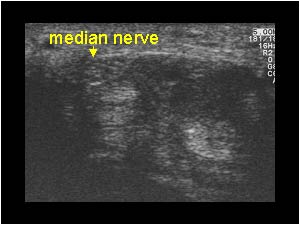Mass ventral of the flexor tendons displacing the median nerve