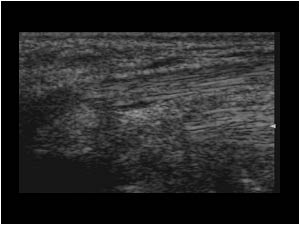 Normal left flexor carpi radialis tendon longitudinal