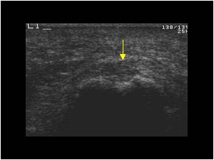 Thickened plantar fascia on the left side transverse
