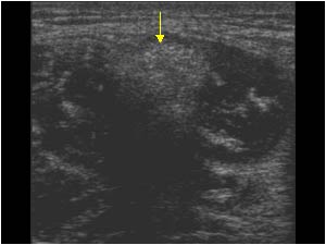 Old hamstring rupture with fibrosis transverse