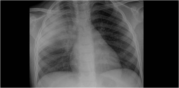 Lobar pneumonia and inhomogeneous infectious spleen and renal failure with hyperechoic kidneys in a 5 year old child