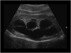 Ureteropelvic junction stenosis resulting in dilatation longitudinal