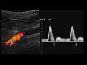 Normal doppler signal in the external iliac artery