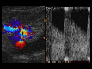 Doppler signal with high velocity and low resistance in the fistula