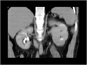 Anomalies related to the ureteral bud
