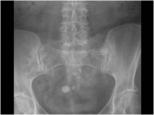 Renal and pelvic stones