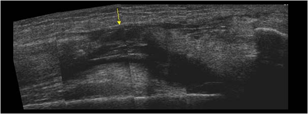 Quadriceps tendon rupture with a large defect longitudinal