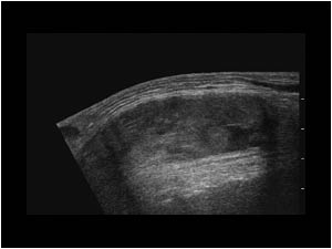 Meniscal cyst in the knee space mimicking a hematoma longitudinal