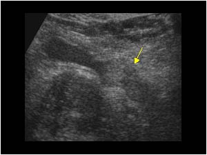 Ureter carcinoma with extension in the ureter longitudinal
