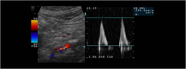 Flow in the true lumen with slightly increased systolic velocity