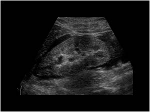 Right kidney with moderate dilatation and perirenal effusion