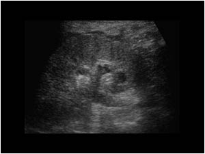 Left kidney with moderate dilatation and small perirenal effusion