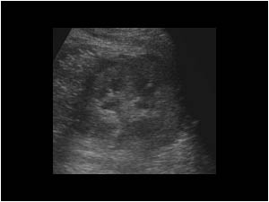 Left kidney with moderate dilatation and small perirenal effusion transverse
