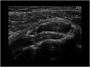 Bursitis anterior of the subscapularis tendon transverse
