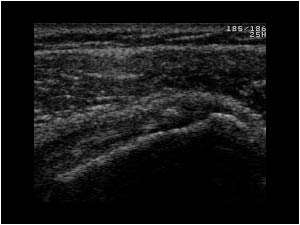 Normal bursa and subscapularis tendon with small calcification transverse