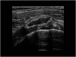 Bursitis anterior of the subscapularis tendon transverse