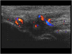 Synovial thickening with hypervascularity longitudinal