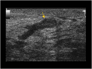intraductal papilloma sonography