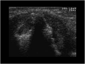 Irregular ulnar styloid process with a synovial mass