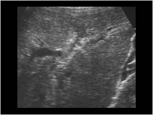 Thickened wall of the intrahepatic bile ducts