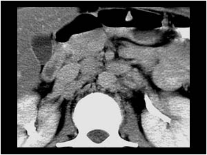 Enlarged mesenteric and retroperitoneal lymphe nodes CT
