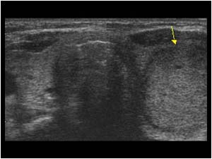 Hyperplastic adenomatous nodule in the left thyroid lobe transverse