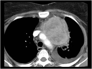 Large lung carcinoma