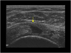 Supraspinatus tendon rupture with a full thickness defect transverse