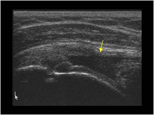 Supraspinatus tendon rupture with a full thickness defect longitudinal