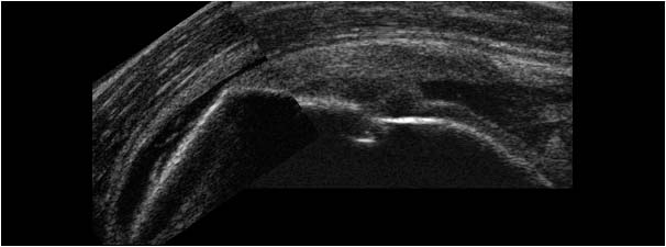 Supraspinatus tendon rupture with a full thickness defect and fluid filled bursa longitudinal