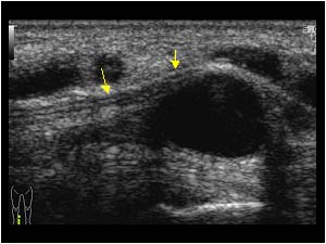 Ganglion cyst with compression of the tibial nerve longitudinal