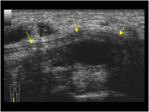 Ganglion cyst with compression of the tibial nerve longitudinal