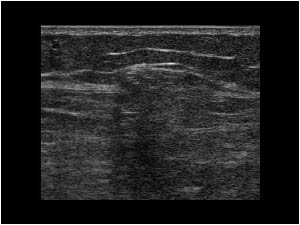 Muscle hernia with a defect in the muscle fascia longitudinal