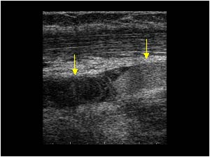 Thrombus in the proximal brachial vein (left) and slow flow in the vein (right)
